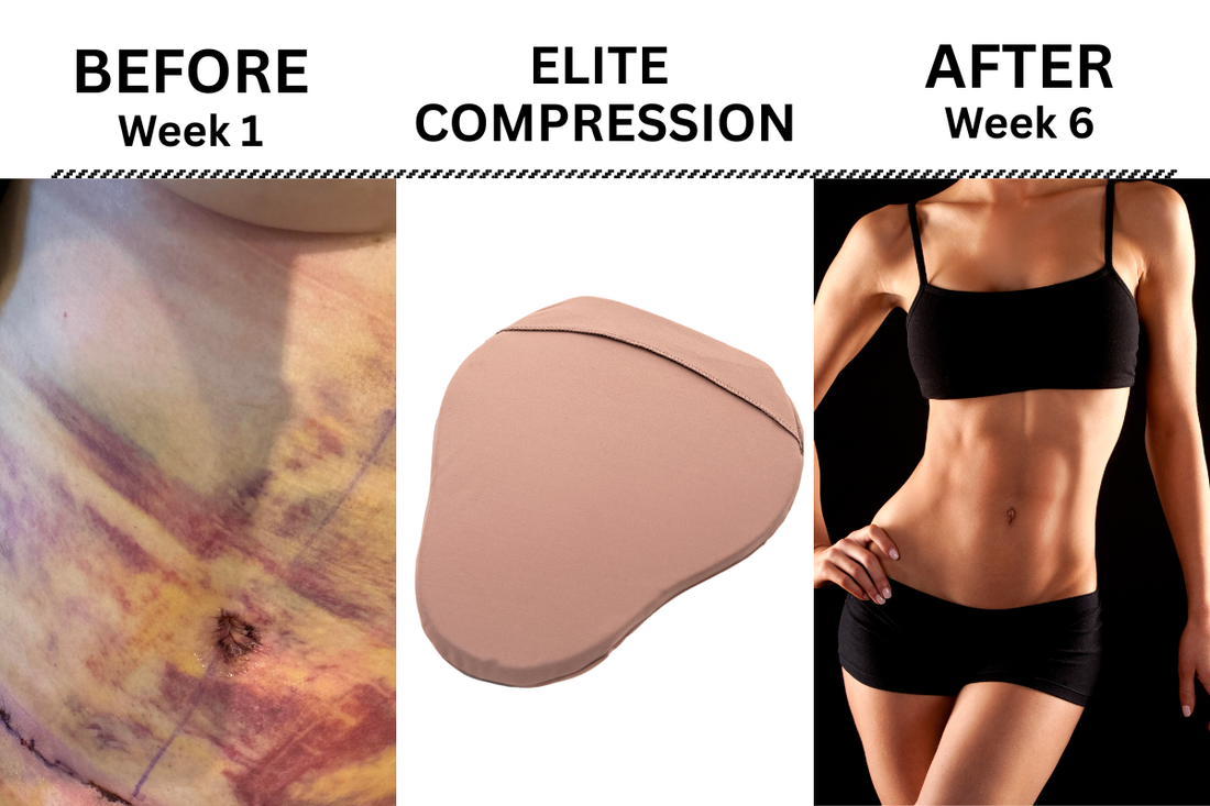 7 Essential Tummy Tuck Recovery Tips: Expert Advice for Faster Healing and Smoother Results